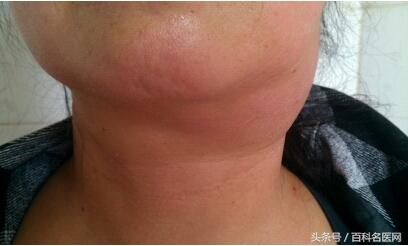 颈部淋巴结肿大警惕鼻咽癌,颈部淋巴结突然肿大是淋巴癌吗