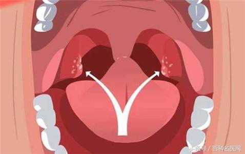 扁桃体发炎怎么办最快最有效缓解,扁桃体发炎高烧39.5度反复发作