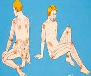 卧床老人的褥疮什么样,卧床老人的褥疮怎么治效果最好