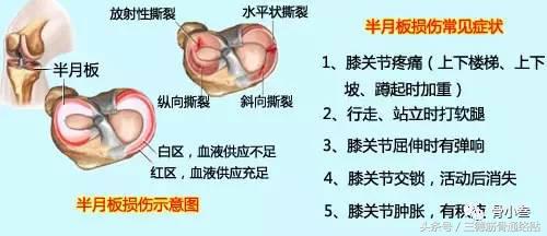 拿什么拯救你，我半月板！