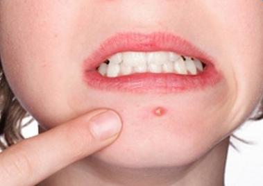 下巴两边脖子长痘痘是什么原因,嘴巴下巴周围长痘痘是什么原因