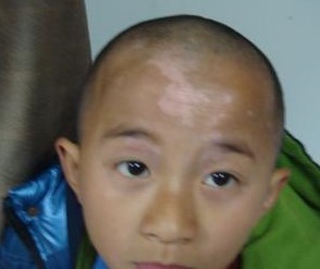 小孩子患上白斑怎么办?饮食也要多注意?