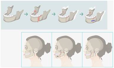 矫正的牙齿又反弹了怎么补救,矫正过的牙齿又反弹了怎么办