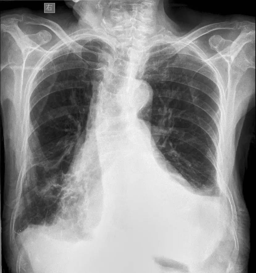 胸片怎么看胸膜粘连还是胸腔积液,胸片上怎么看局部胸膜增厚