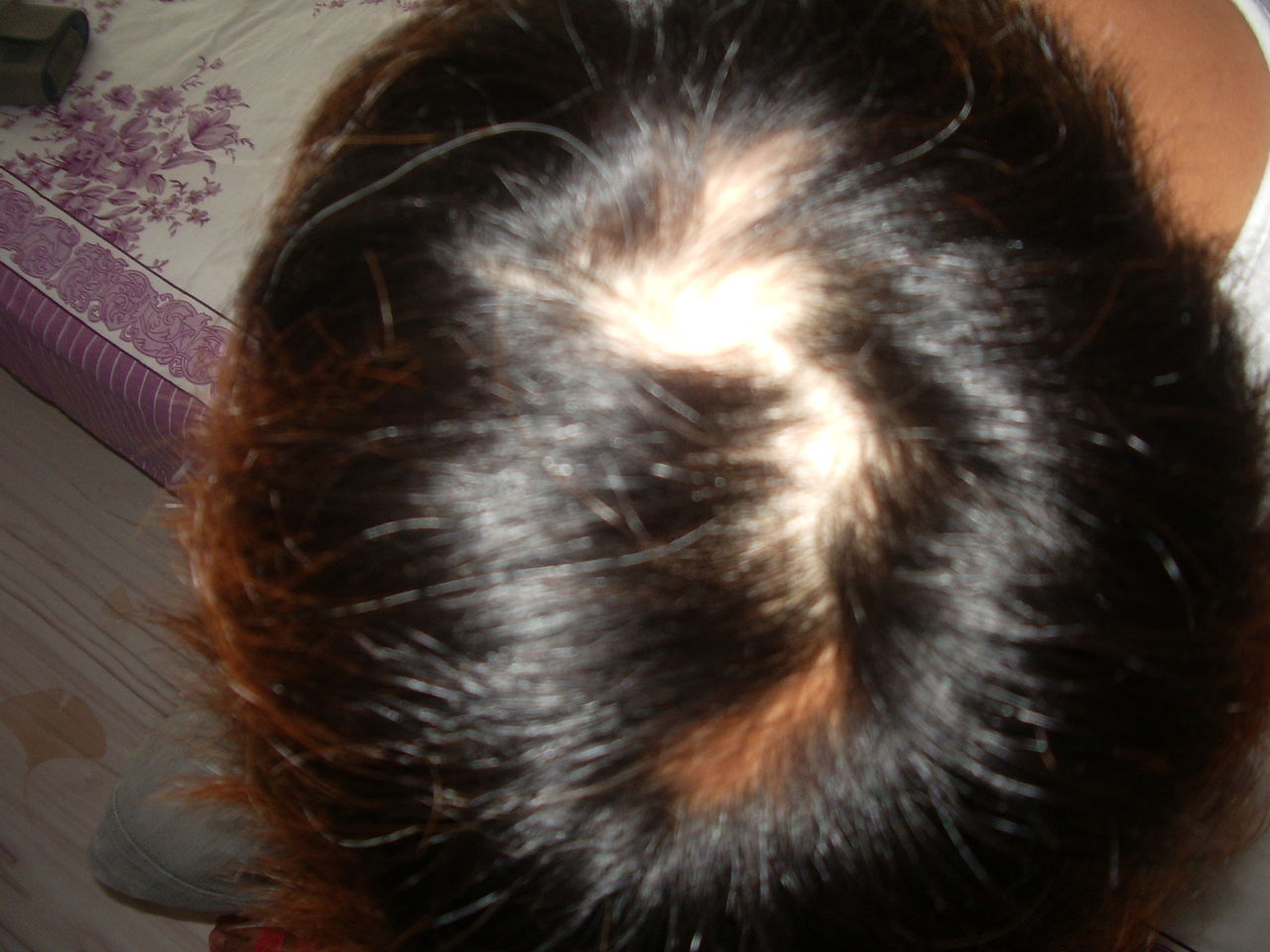 年轻人头顶脱发能恢复是真的吗,为什么现在的人脱发掉发严重