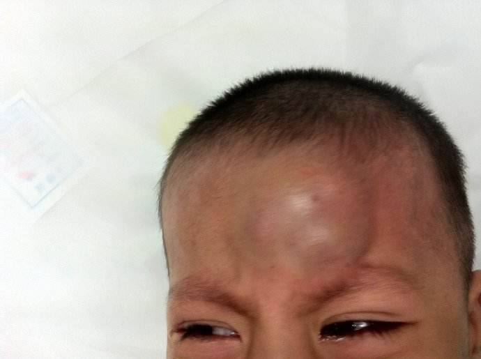 撞了以后用冰水还是热水敷,脑袋撞个包用热水敷还是凉水