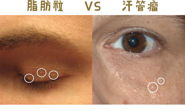 眼睛下边脂肪粒怎么去除小妙招,眼睛下边长了脂肪粒