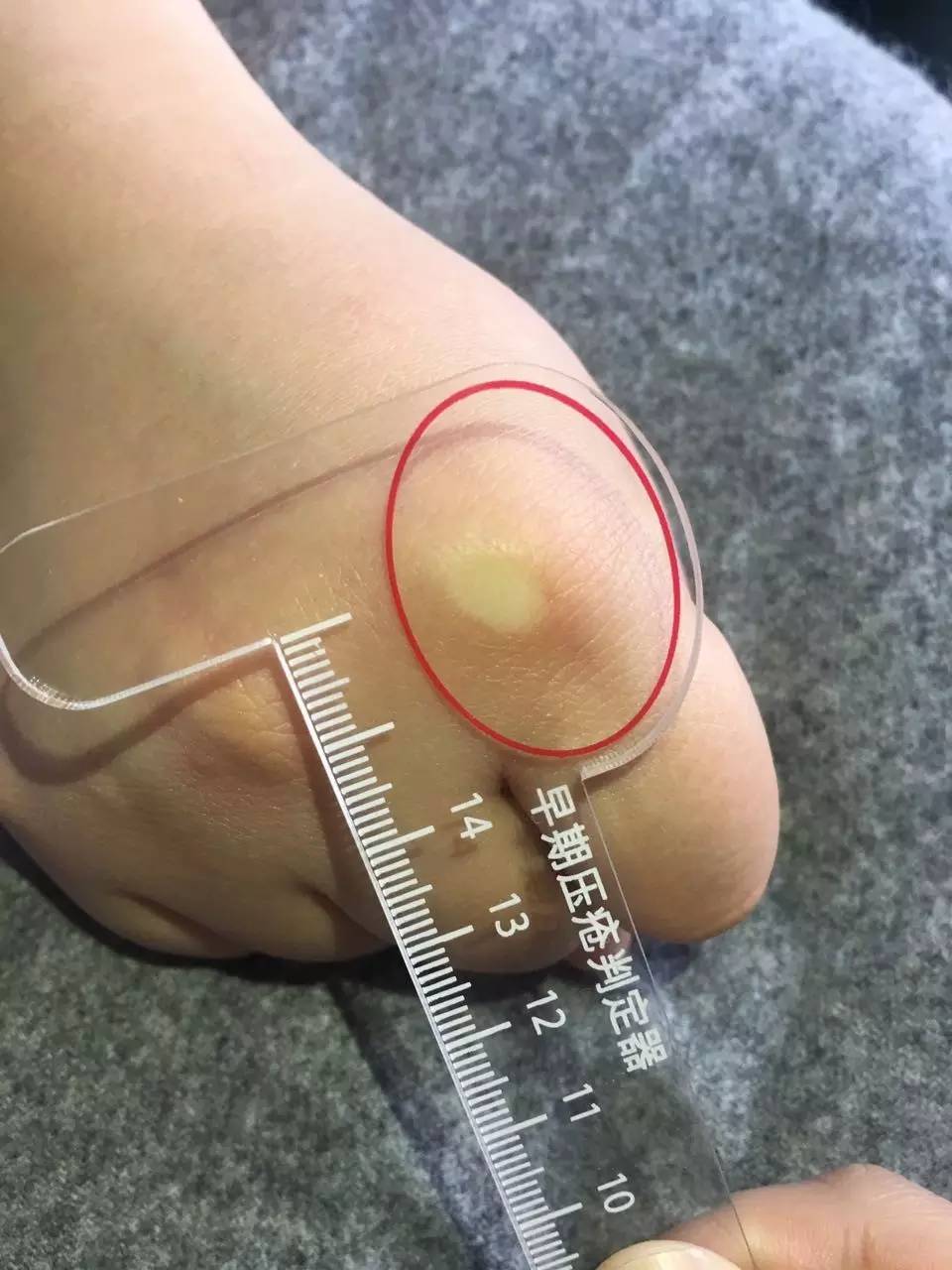 压疮的五大误区,压疮最新指南解读是哪一年的