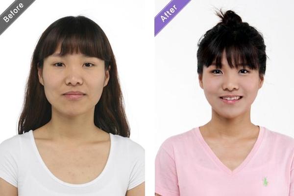 婴儿肥可以瘦下来吗？这样做婴儿肥减下去就很简单