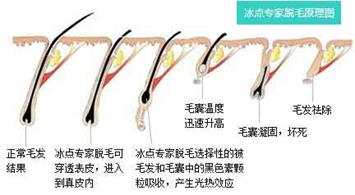 冰点脱毛10次了还是长毛怎么办,冰点脱毛越脱越多怎么办啊