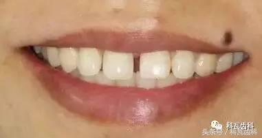 门牙旁边有缝最好的解决方法,门牙缝漏怎么补救