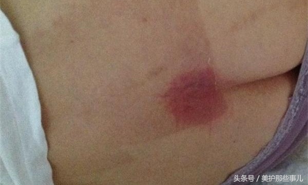 褥疮发炎可用碘伏消毒再抹膏药吗,褥疮能不能用黑药膏和红霉素