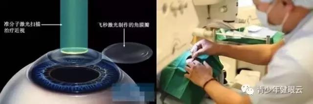 近视眼球运动训练,近视可以靠眼球运动改善吗