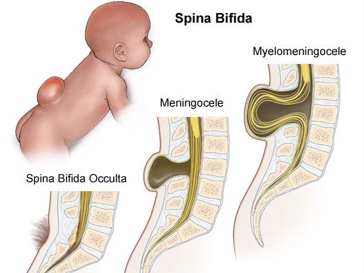 隐性脊柱裂属于先天性疾病吗,先天脊柱裂是先天疾病吗