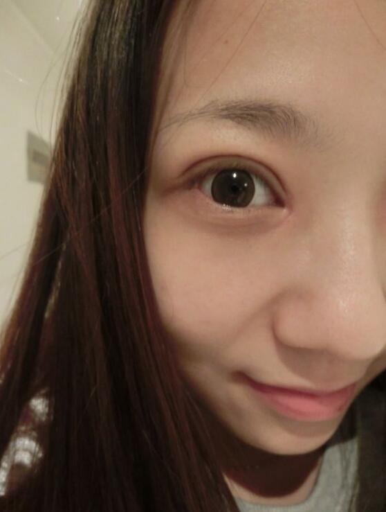 完美的埋线双眼皮,完美双眼皮