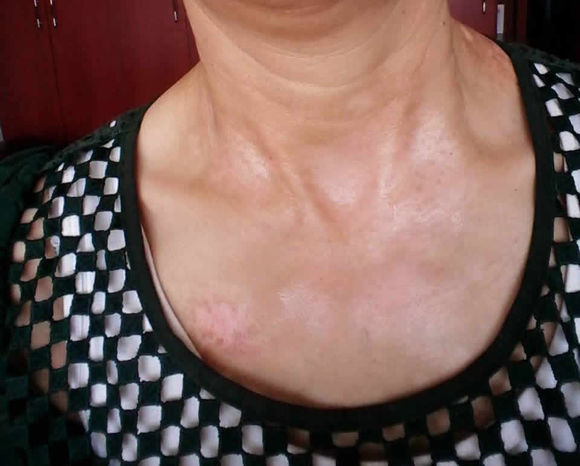 有人说白癜风治不好真的吗,白癜风谣言汇总