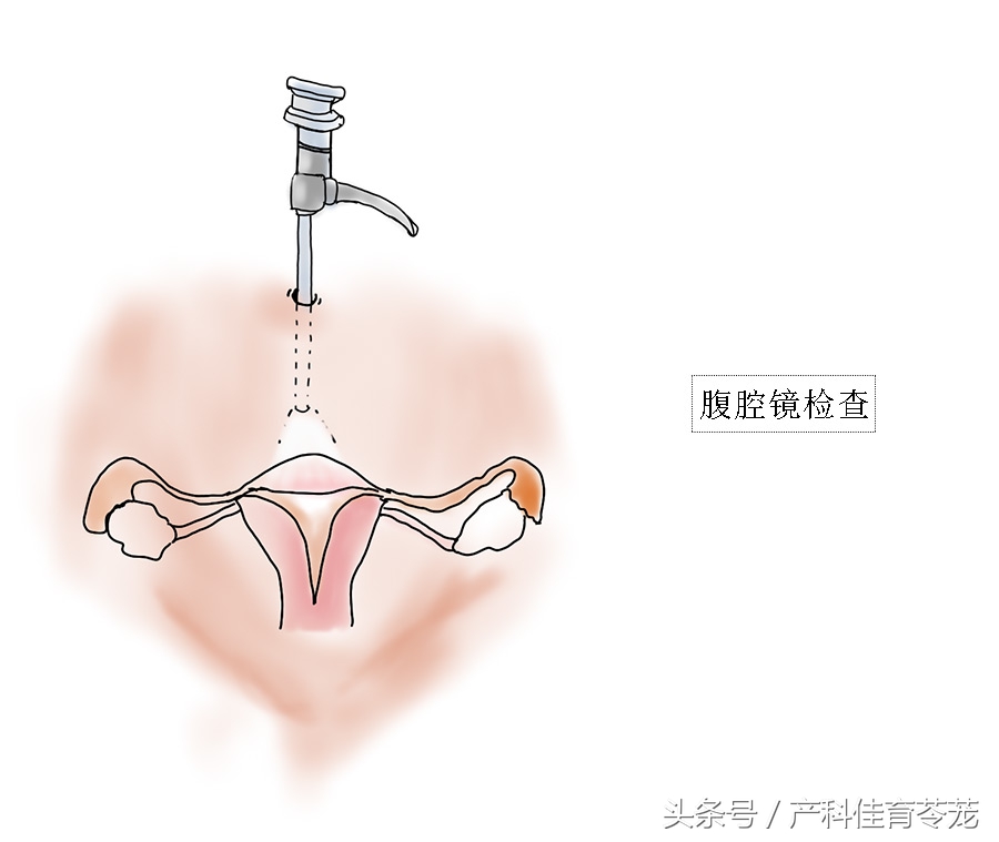 痛经有可能是癌症吗,痛经可能是妇科炎症吗