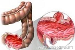 得了结肠炎还会胖吗,怀孕得了结肠炎