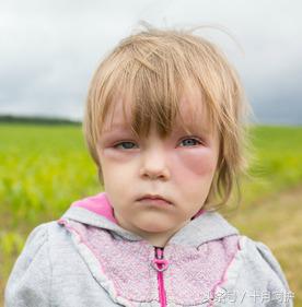 小孩食物过敏引起皮肤红疹怎么办,原来这些才是春季花粉过敏的元凶