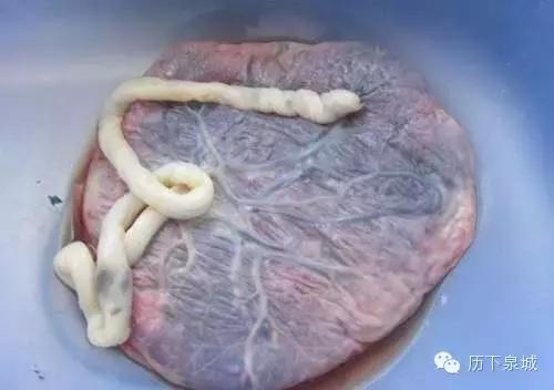 胎盘剥离征象,胎盘低置状态