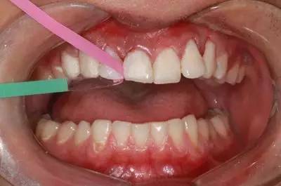 可乐牙治疗实拍,可乐牙治疗好前后图片