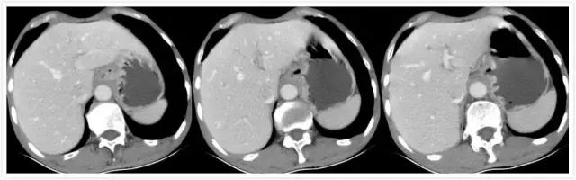 胃底贲门中分化腺癌怎么来根治,胃底贲门低中分化腺癌能治愈吗