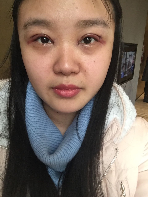 全切双眼皮感觉很窄后期会变宽嘛,内双的人割双眼皮会更自然吗