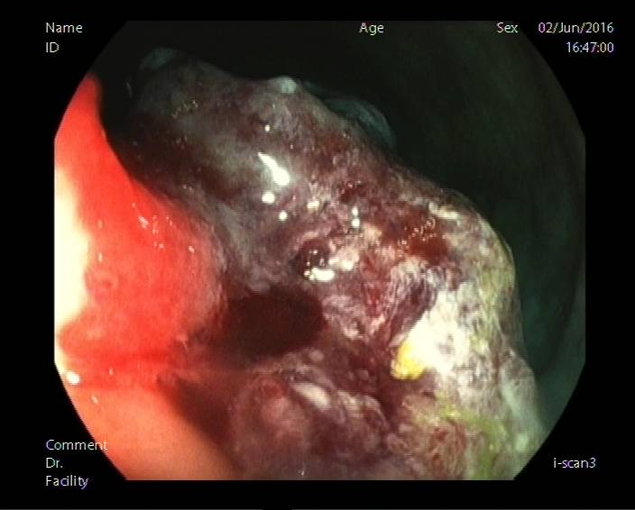 普通内镜与Pitpattern分型（多图详解）