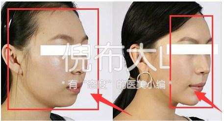 垫下巴鉴定,垫下巴看得出来吗