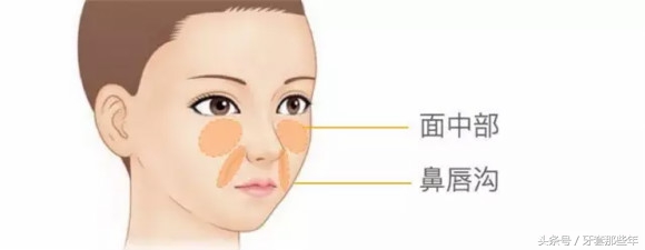 戴牙套矫正要打骨钉吗,矫正先拔牙还是先戴牙套