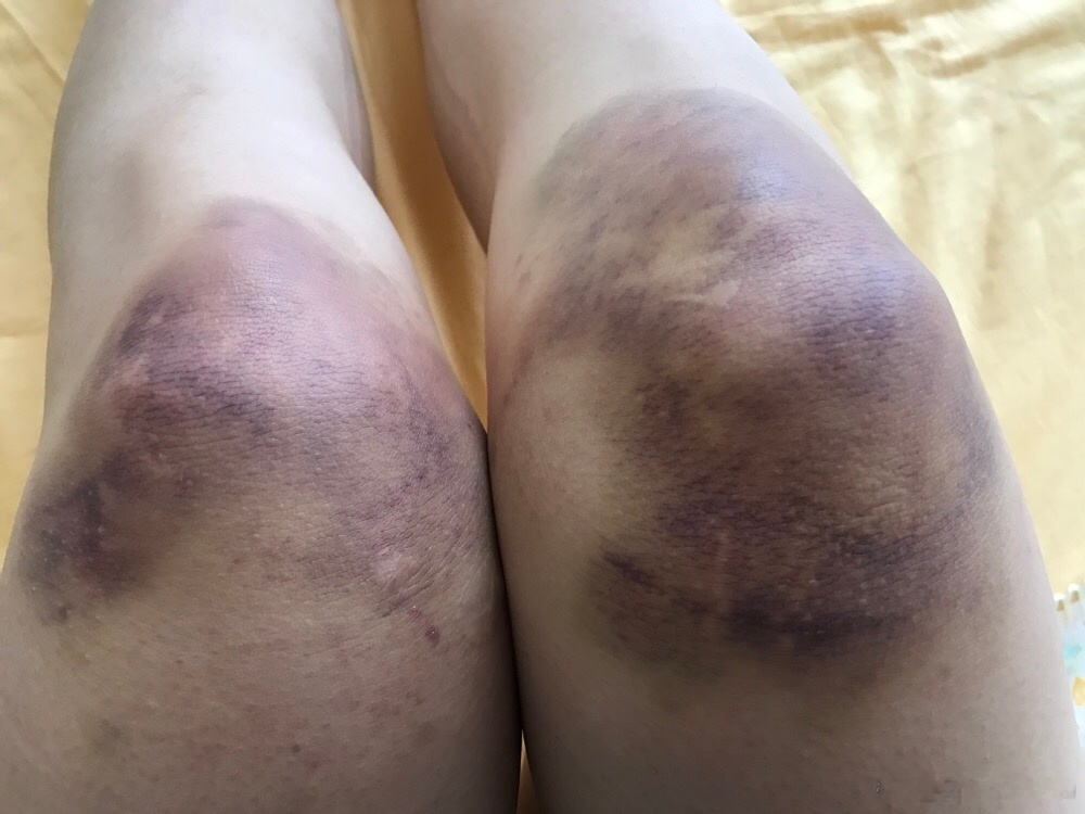 运动员的背后你知多少?训练练到双膝红肿淤青,甚至脚趾盖磨掉!