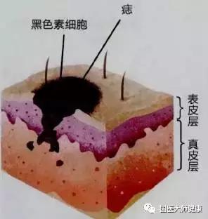 突然长出来的痣要切吗,乳房突然长痣会癌变吗