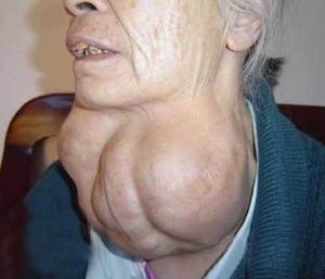 甲状腺增大出现什么症状,甲状腺肿大的症状和治疗方法