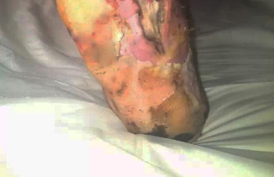 脚上破皮有小豆,脚上破皮无法痊愈怎么回事