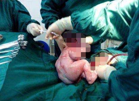 一层层，一刀刀切开孕妇肚子，剖腹产并不是你想象的那么简单