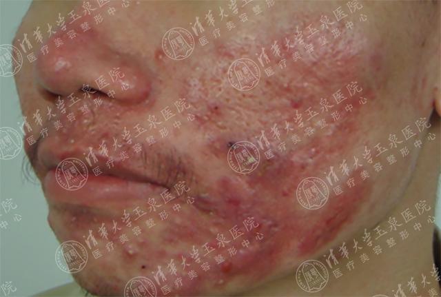 最近脸上疯狂长痘是因为换季吗,一换季脸就起痘