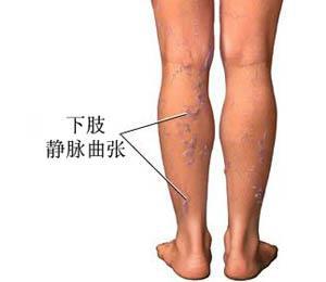 腿肚上青筋明显但不突出会怎样,腿肚子上有青筋能消除吗