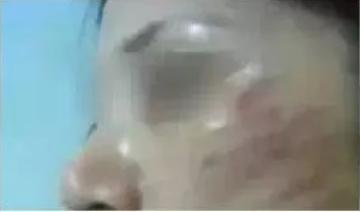 脸部填充脂肪能维持多久,自体脂肪面部填充后遗症