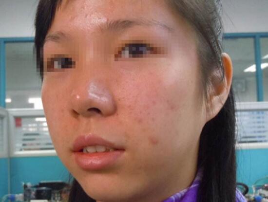 脸上螨虫感染皮肤怎么治疗快,脸上螨虫怎么消除最快方法