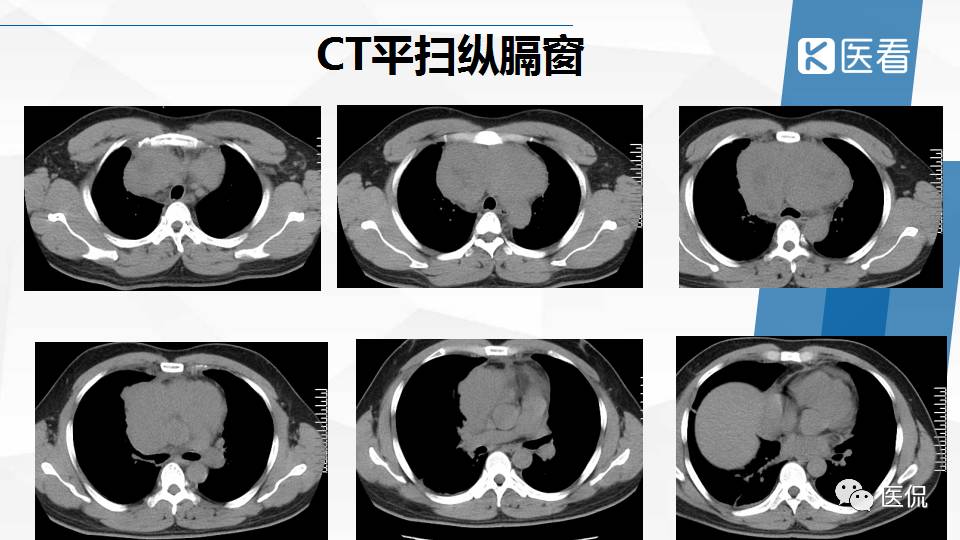 精原细胞瘤ct影像,精原细胞瘤影像特征