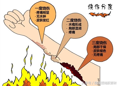 美国烧伤修复手段,红十字会烧烫伤现场处理操作视频