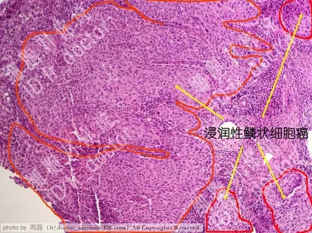 宫颈高度病变镜下观察,宫颈镜下可疑浸润癌严重吗
