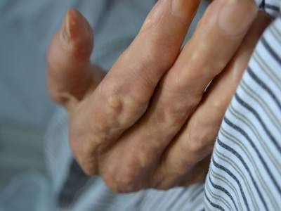 痛风引起的脚趾头疼怎么办,痛风脚趾头长期肿痛吃什么药消肿