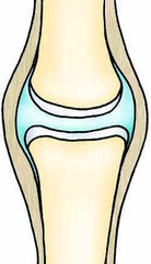 关节缺少润滑油的症状,为什么关节润滑液会少