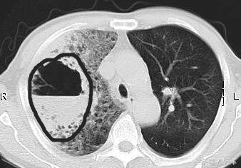 古装剧吐血是什么病,古代剧咳嗽吐血是什么病