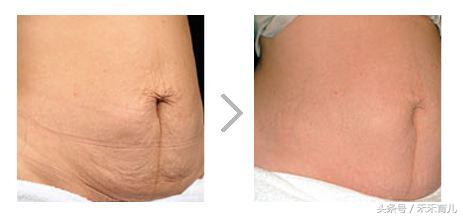 产后收腹带你用对了吗,到底有没有必要用产后收腹带