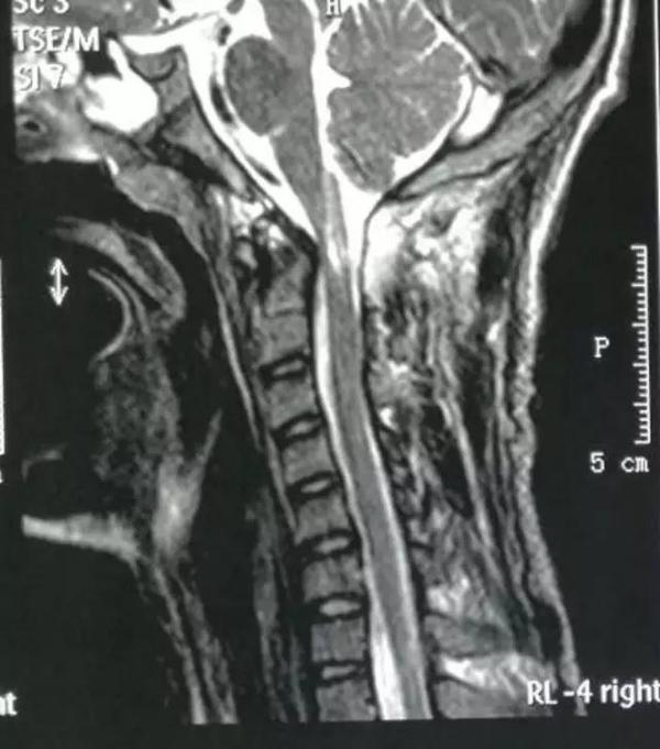 寰枢椎脱位手术适应症,寰枢椎脱位手术最广泛麻醉方法