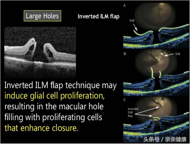 黄斑裂孔怎么治疗,黄斑出血和黄斑裂孔的区别