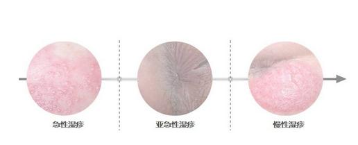 湿疹是因为皮肤太湿了导致的吗,湿疹根本原因中医