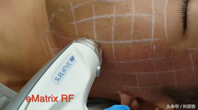 改善毛孔粗大最简单有效的方法,如何有效改善毛孔粗大的方法